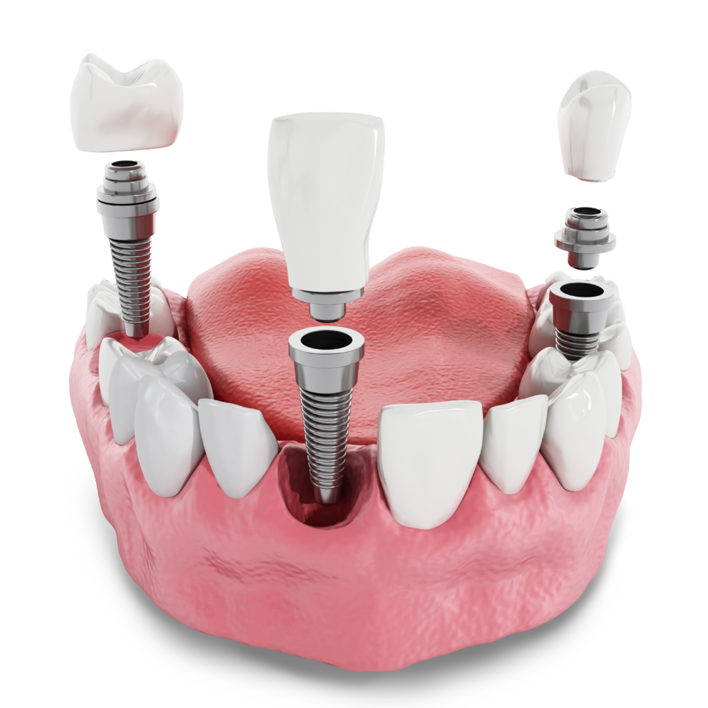 dental implant model Upper Eastside NY