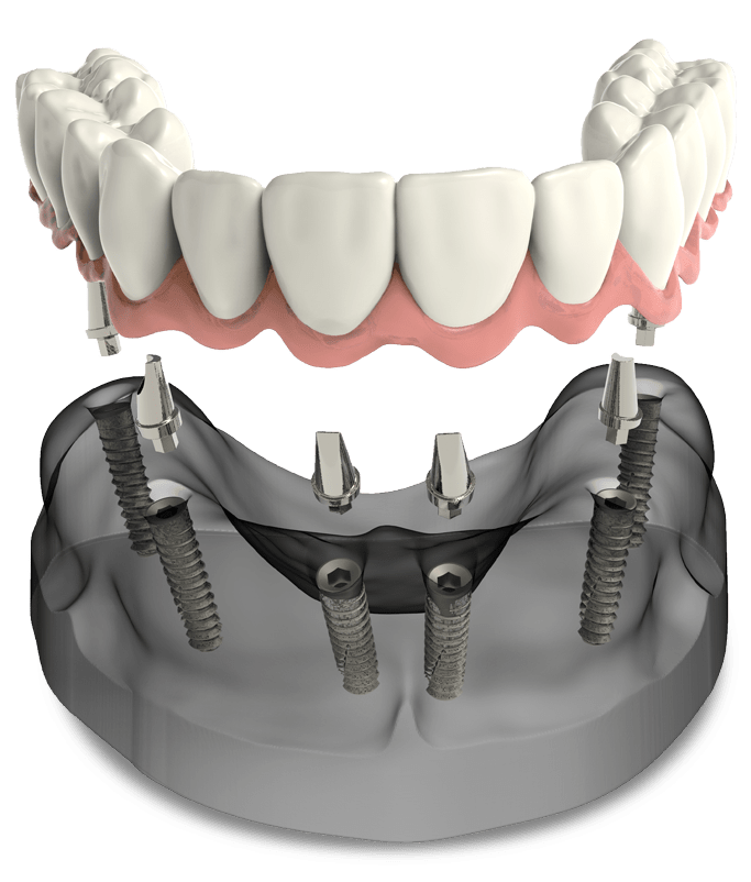 full arch dental implants model Upper Eastside NY