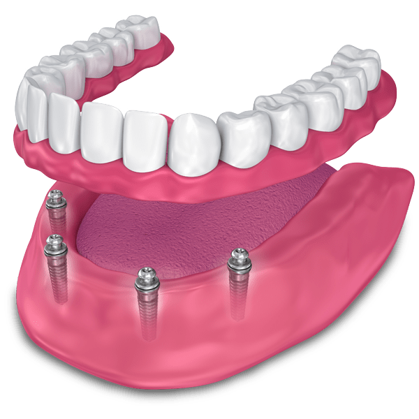 implant supported dentures model Upper Eastside NY
