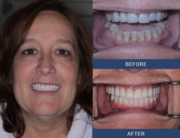 teeth tomorrow Before and after case 10 Upper Eastside NY