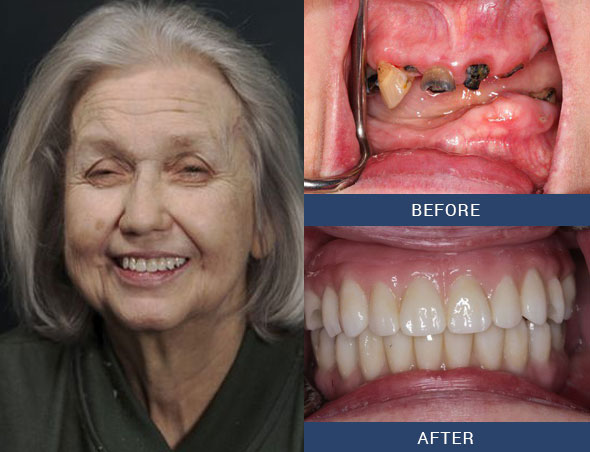 teeth tomorrow Before and after case 11 Upper Eastside NY