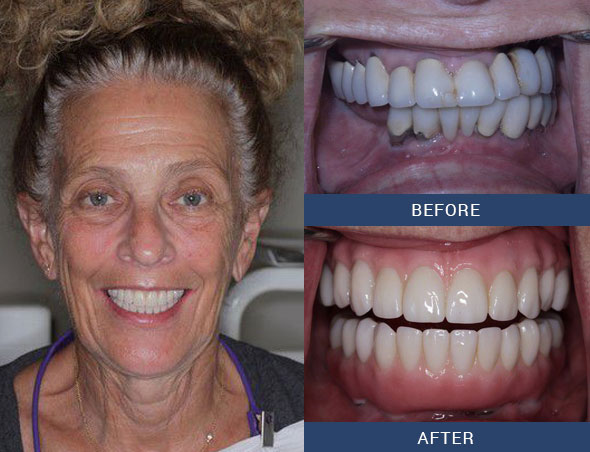 teeth tomorrow Before and after case 12 Upper Eastside NY