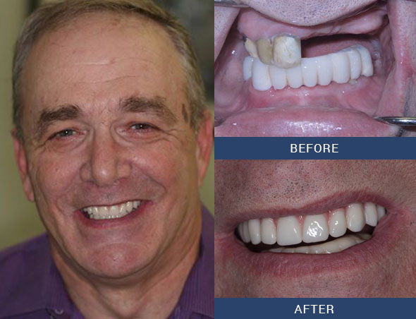 teeth tomorrow Before and after case 13 Upper Eastside NY