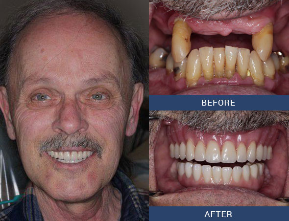 teeth tomorrow Before and after case 14 Upper Eastside NY