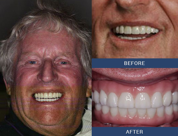 teeth tomorrow Before and after case 15 Upper Eastside NY