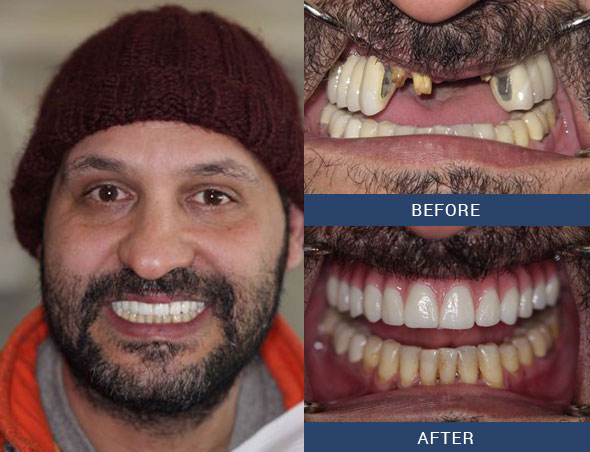 teeth tomorrow Before and after case 16 Upper Eastside NY