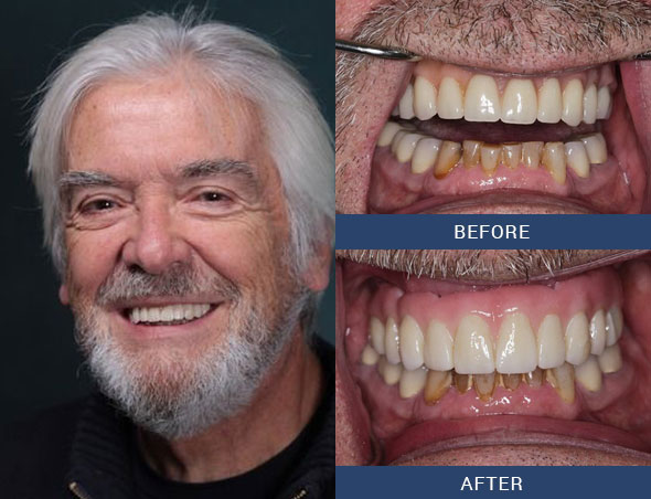 teeth tomorrow Before and after case 2 Upper Eastside NY