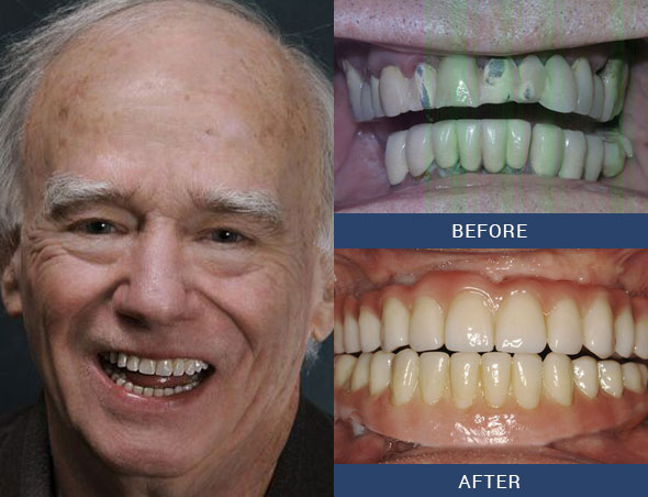teeth tomorrow Before and after case 3 Upper Eastside NY