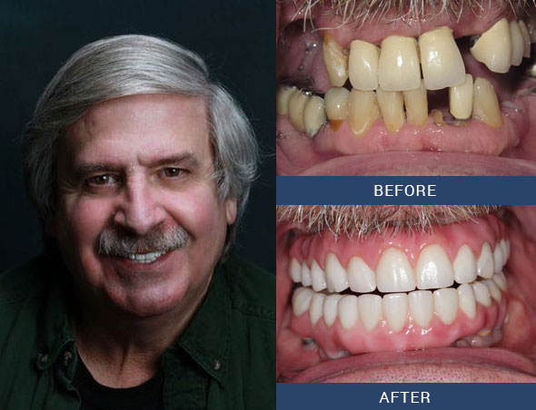 teeth tomorrow Before and after case 4 Upper Eastside NY
