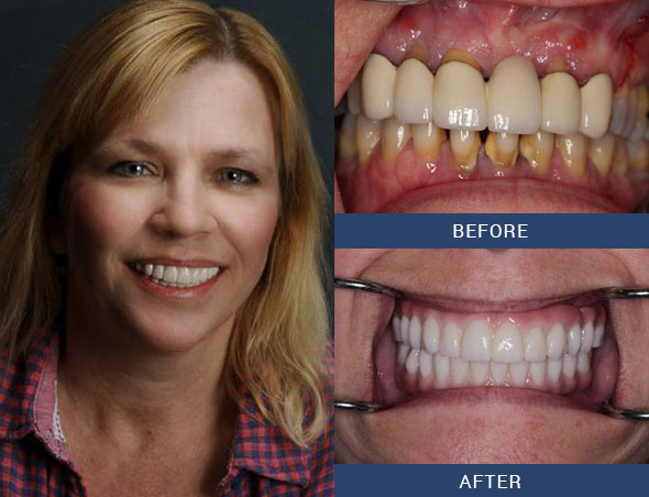 teeth tomorrow Before and after case 5 Upper Eastside NY