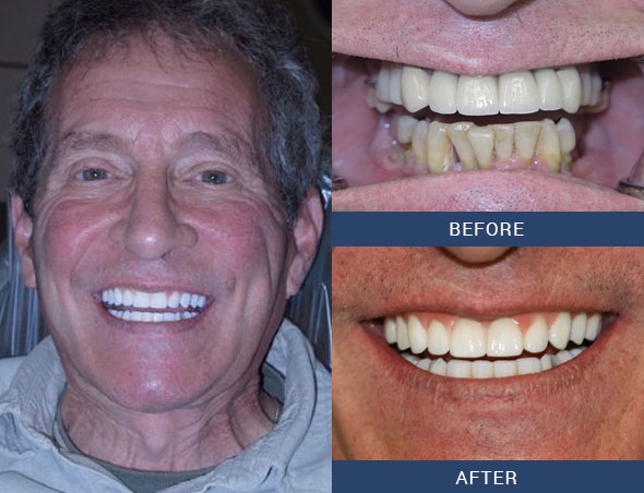 teeth tomorrow Before and after case 1 Upper Eastside NY