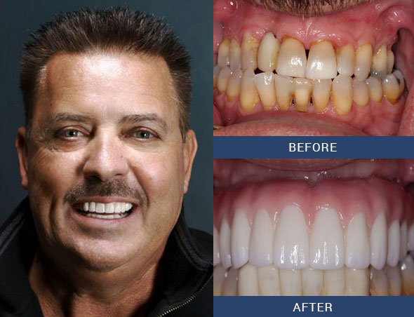 teeth tomorrow Before and after case 8 Upper Eastside NY