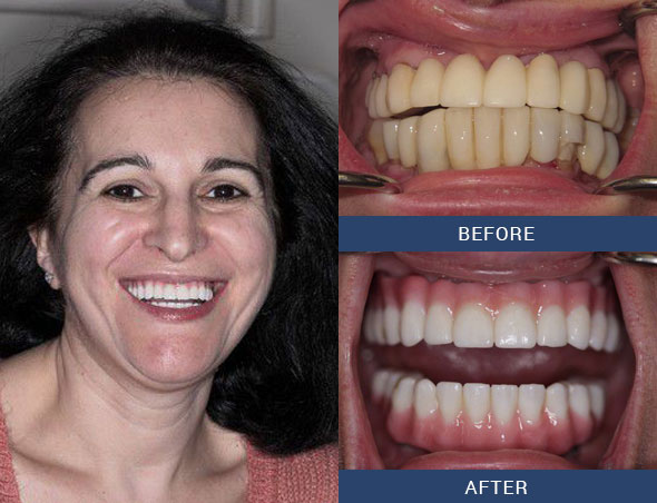 teeth tomorrow Before and after case 9 Upper Eastside NY