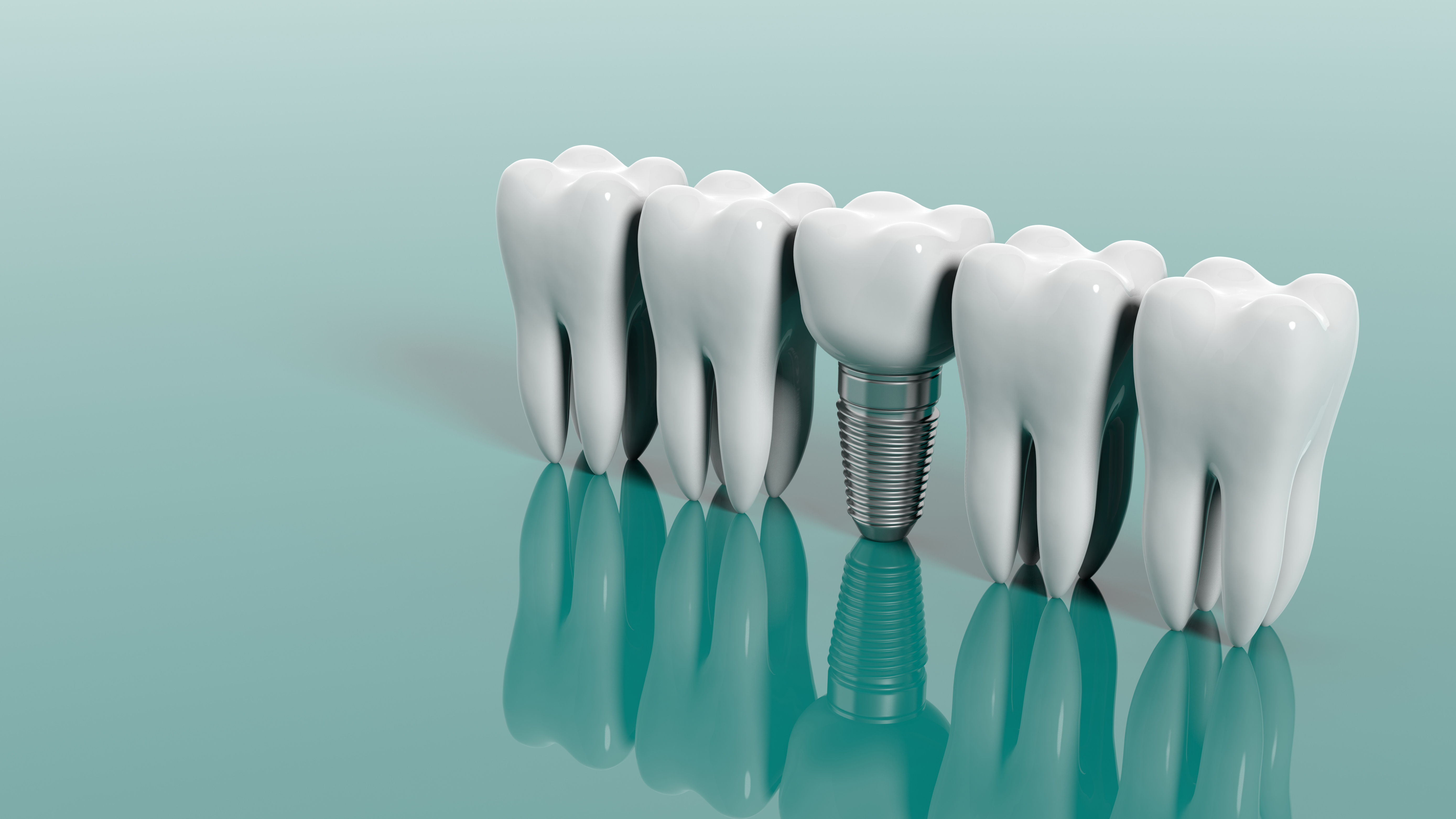 What Happens During the Dental Implant Placement Procedure?