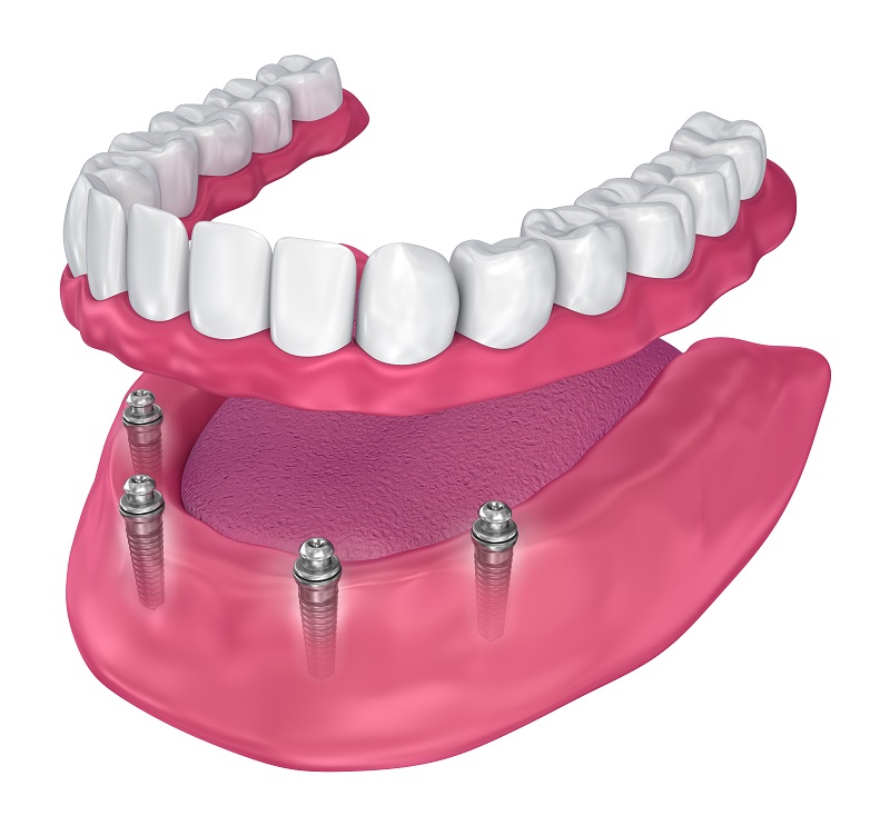 implant supported dentures manhattan ny