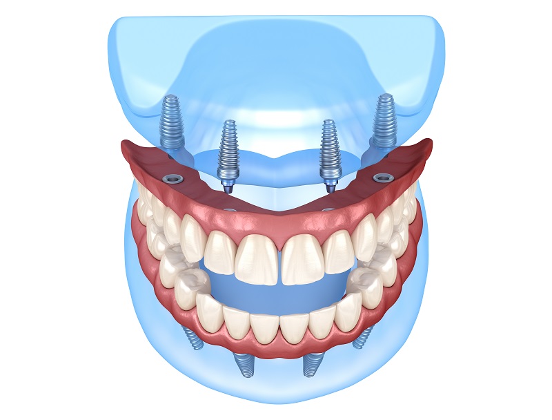 dental implants manhattan ny
